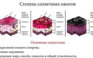 Степень солнечного ожога с фото