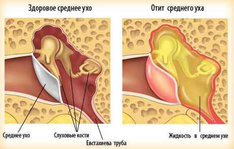 Фото отита среднего уха у взрослых