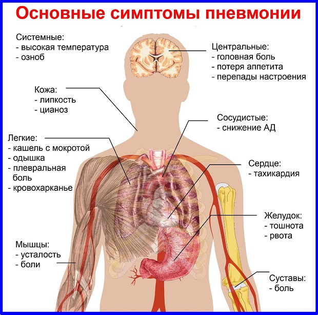 Признаки воспаления легких